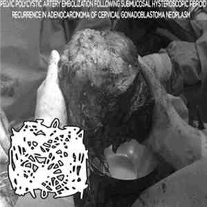 Stromal Myoma - Pelvic Artery Embolization Following Submucosal Hysteroscopic Fibroid Recurrence in Adenocarcinoma of Cervical Gonadoblastoma Neoplasm mp3